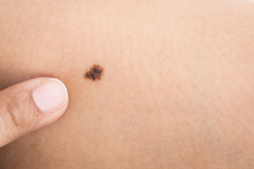 mole on skin